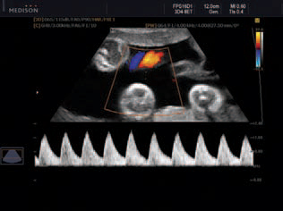 Köldökzsinór zoomolt triplex módú Doppler képe Köldökzsinór zoomolt triplex Doppler képe