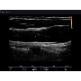 Accuvix V20 Auto IMT vastagságmérés képe